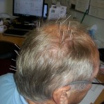 head acupuncture